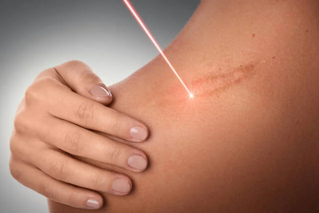 Laser scar removal treatment being performed on a patient's arm