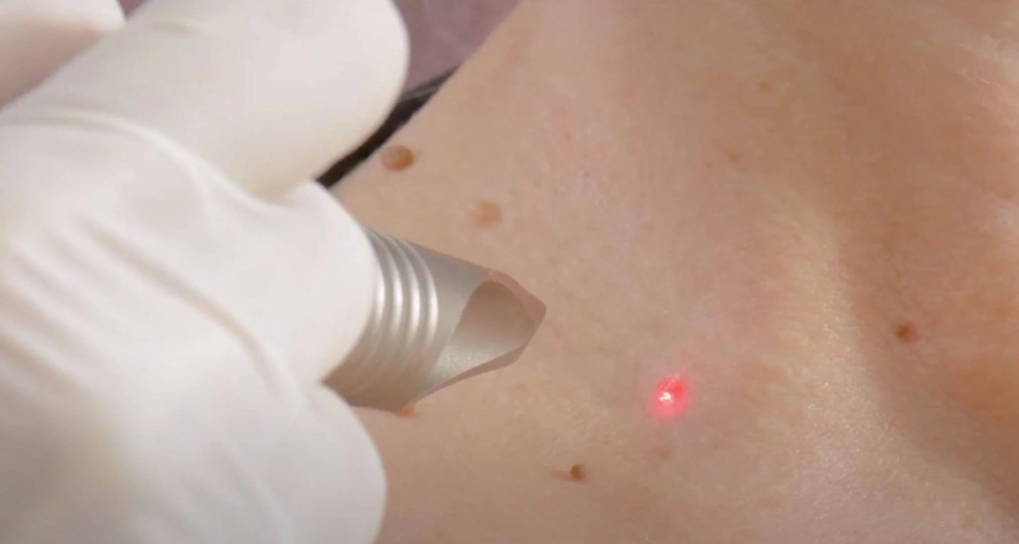 Laser treatment being performed on a patient's shoulder with visible benign skin lesions