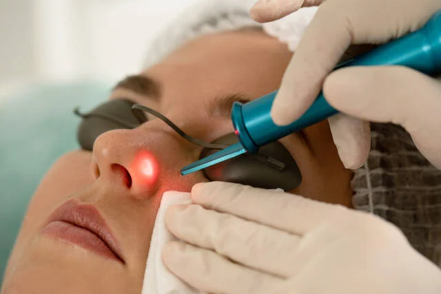 Laser mole removal treatment being performed on a patient's skin