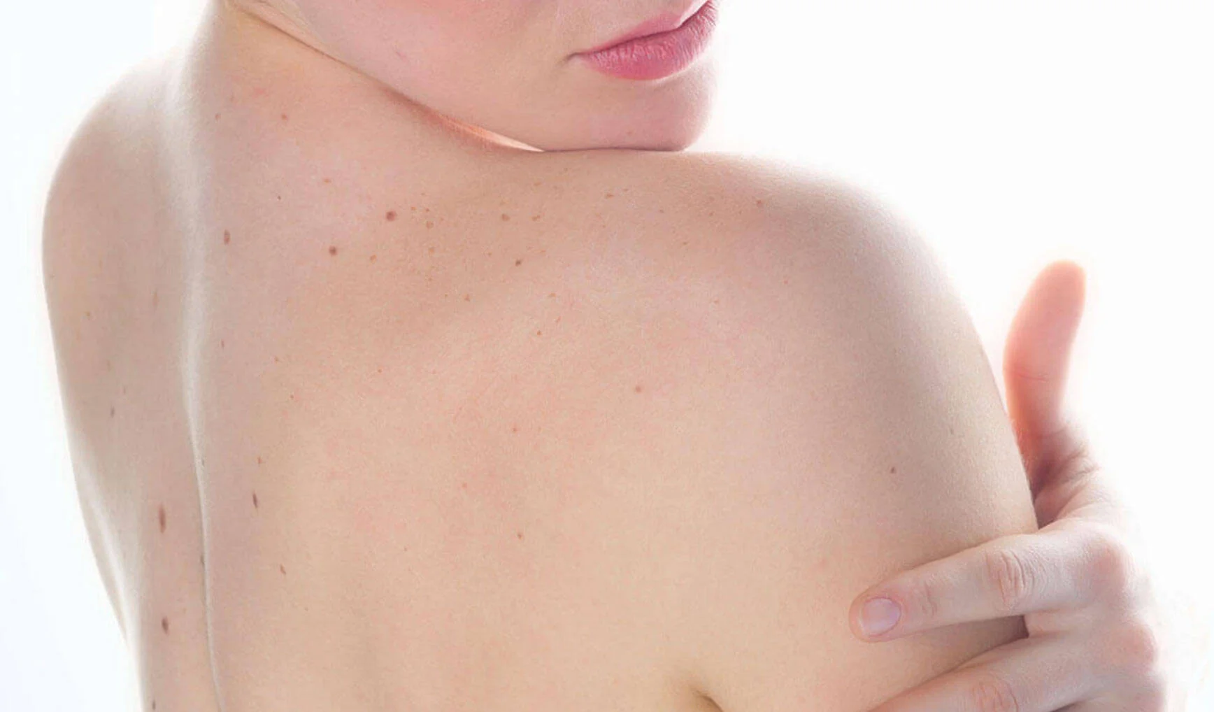 Close-up of a person's shoulder and neck with visible skin marks