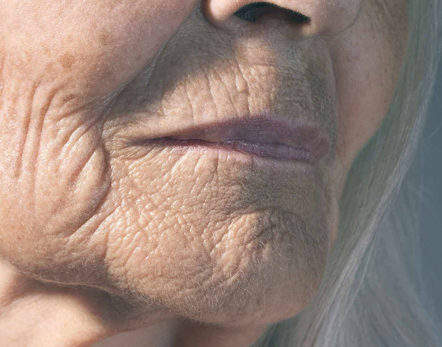 Wrinkle and Facial Lines