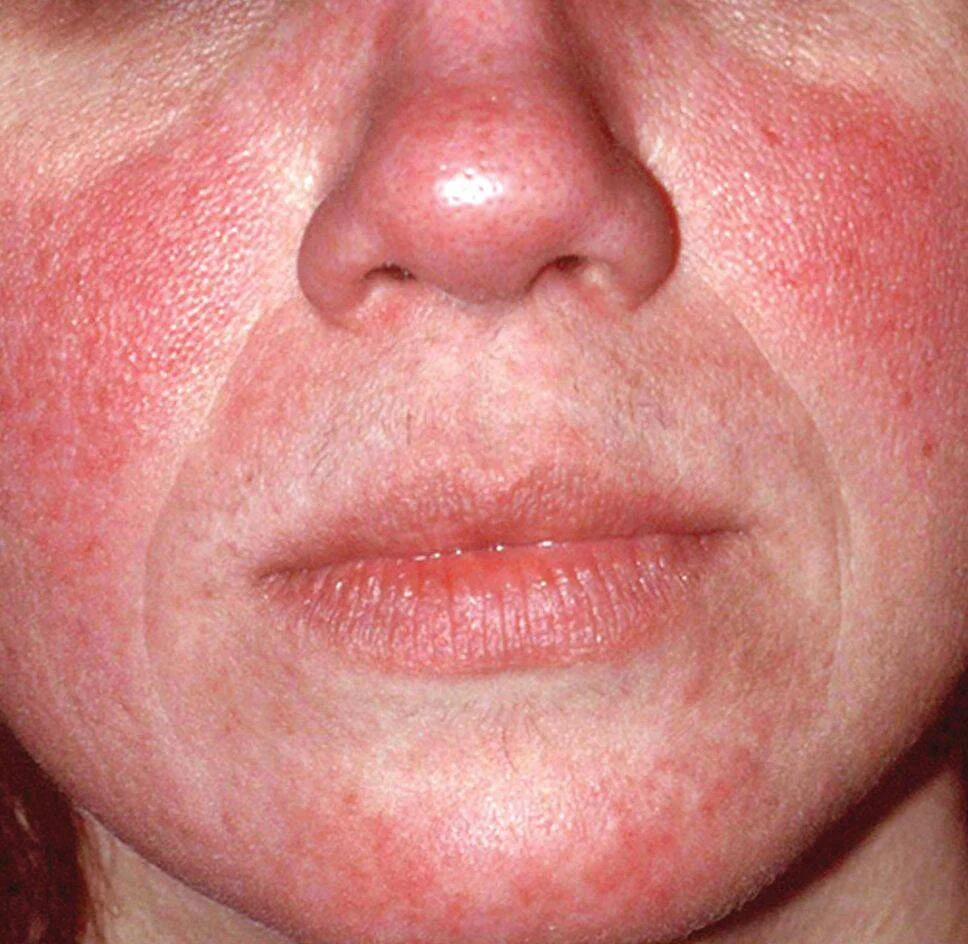 Close-up of a person's face showing rosacea redness across the cheeks and nose