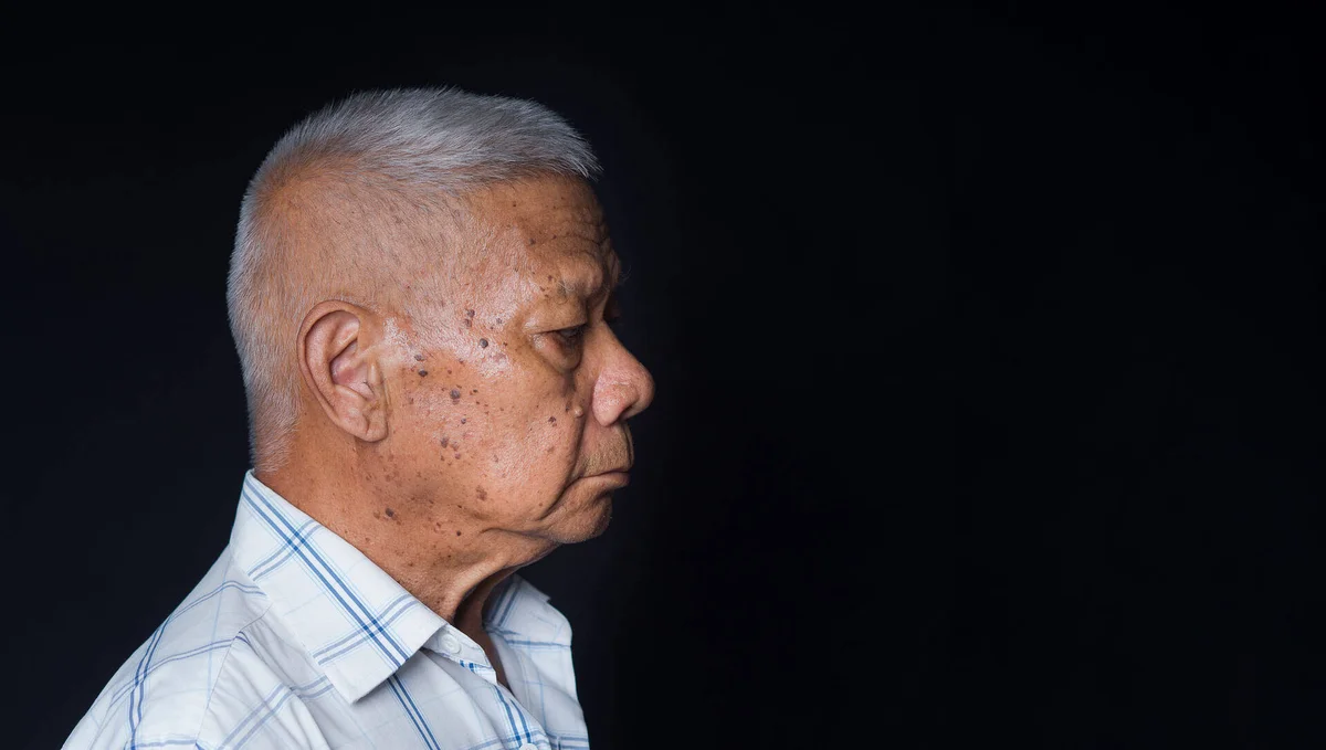 Profile portrait of an older man showing age spots and pigmentation on his face