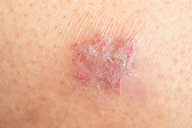 Close-up of a solar keratosis lesion on skin