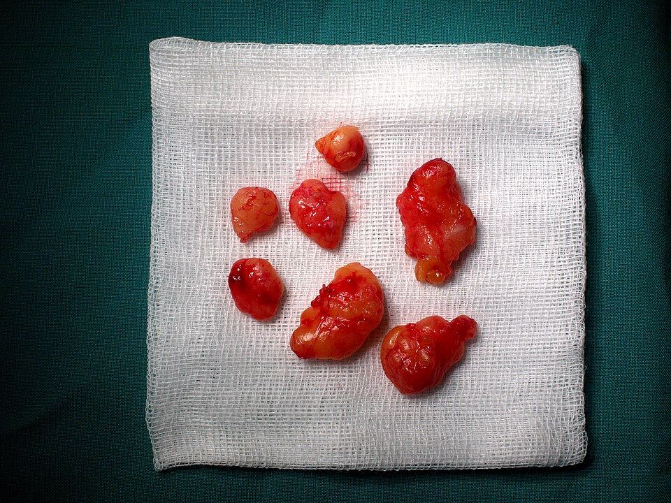 Representative clinical photograph of Lipoma