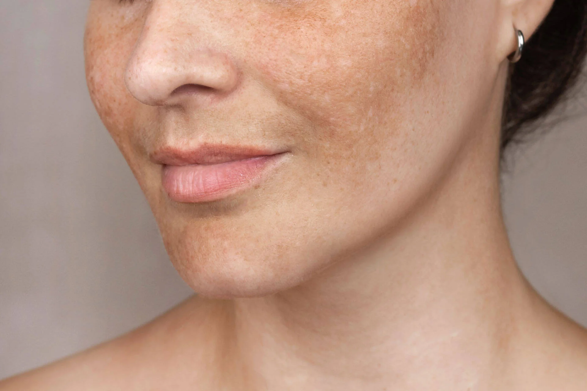 Close-up of a woman's face showing melasma pigmentation on her cheek