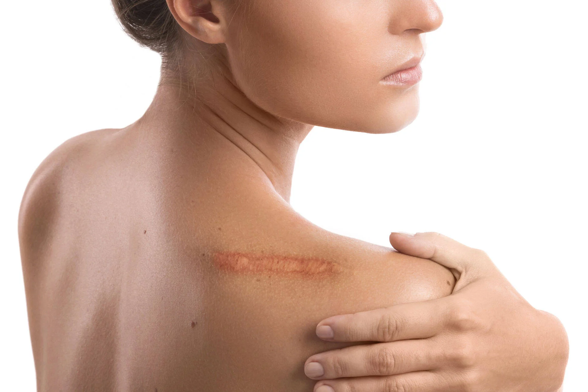 Close-up of a healed scar on a person's shoulder
