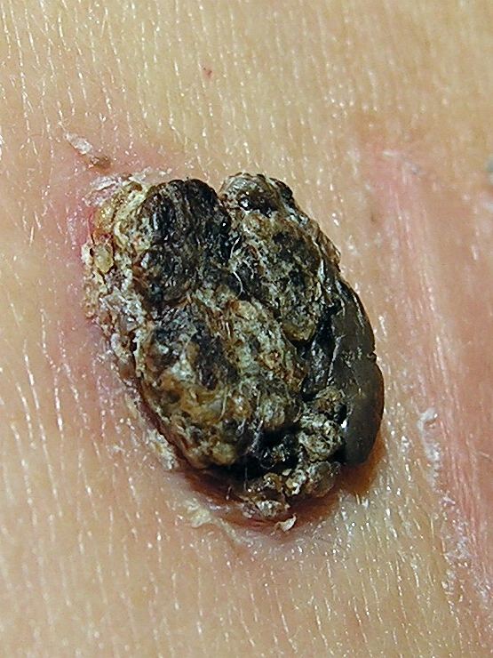 Representative clinical photograph of Seborrhoeic keratosis