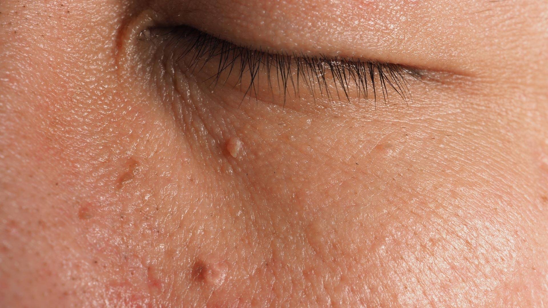 Close-up of skin around the eye showing small benign skin lesions