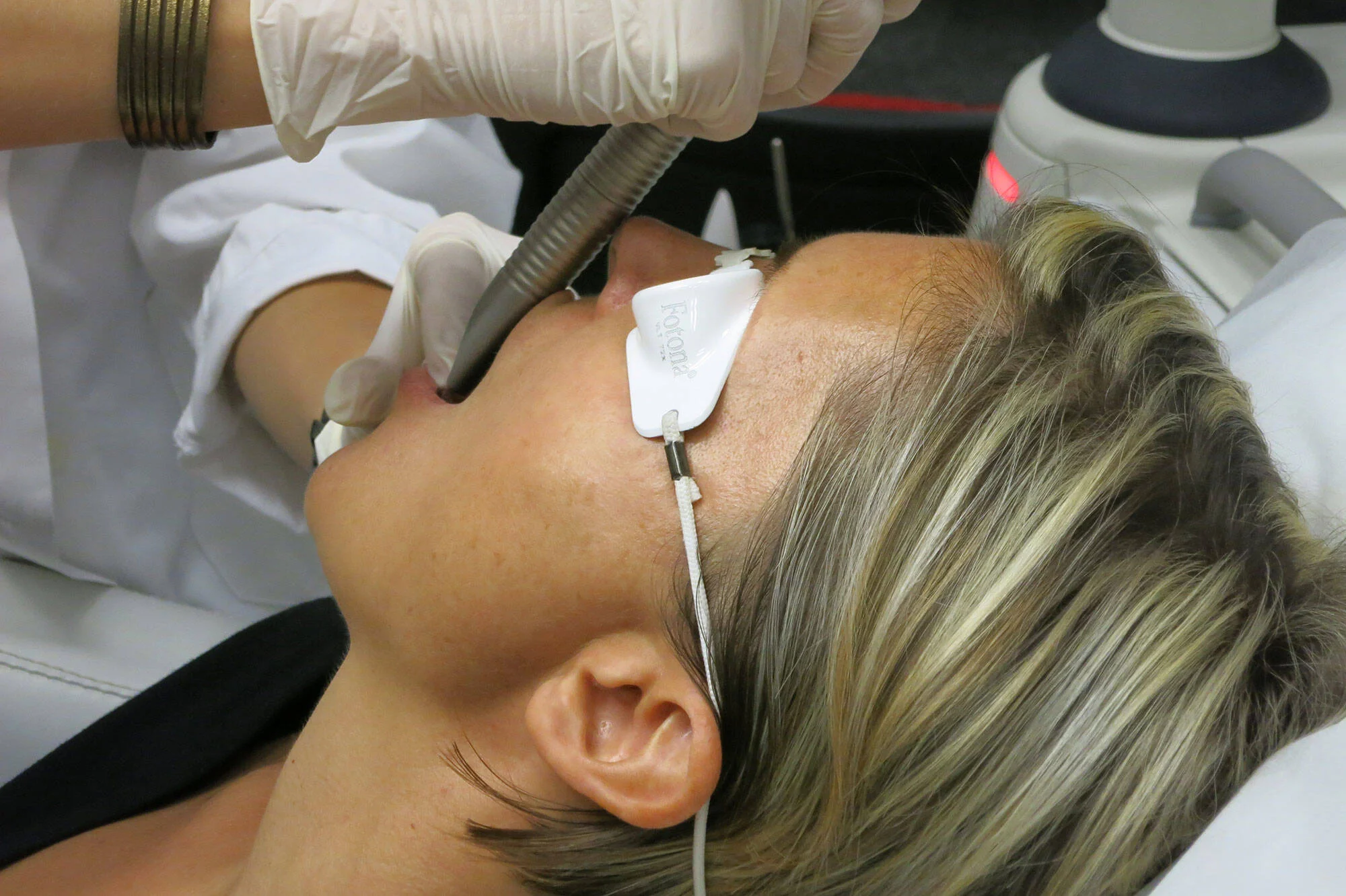 Fotona 4D laser face lifting procedure being performed on a patient