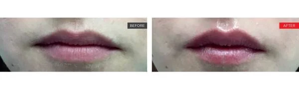 LipLase treatment illustration